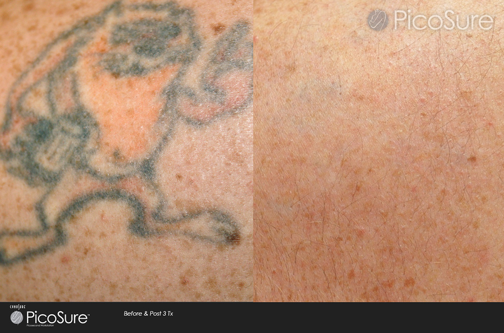 My tattoo removal progress with PicoSure laser  rTattooRemoval